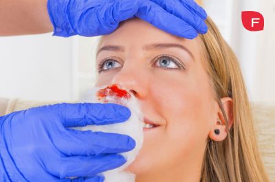 Epistaxis o hemorragia nasal, ¿cómo evitarla y tratarla?