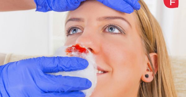 Epistaxis o hemorragia nasal, ¿cómo evitarla y tratarla?