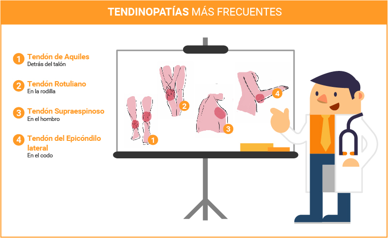 Tendinitis rotuliana y otras tendinopatías